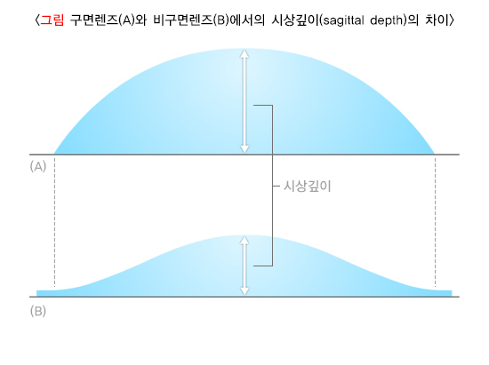 구면렌즈(A)와 비구면렌저(B)에서의 시상깊이(sagittal depth)의 차이